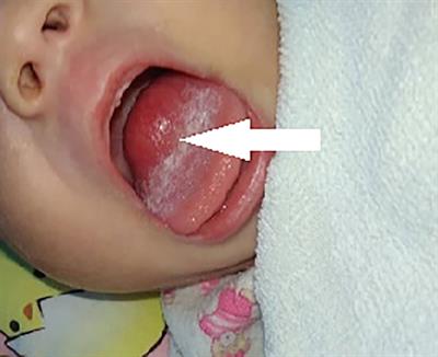 Case report: Clinical features and prognosis of two Infants with rhabdomyosarcoma of the tongue